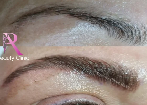 Wenkbrauwbehandeling