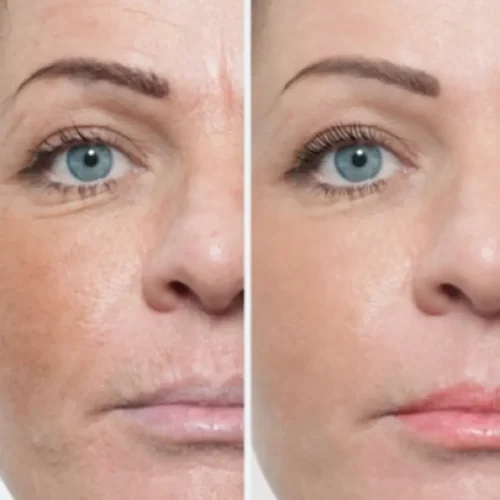 Microneedling Collagen Therapy