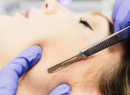 Dermaplaning Amsterdam