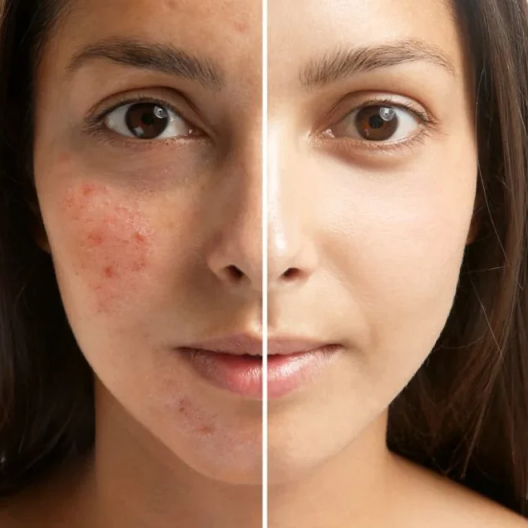 Acne behandeling img