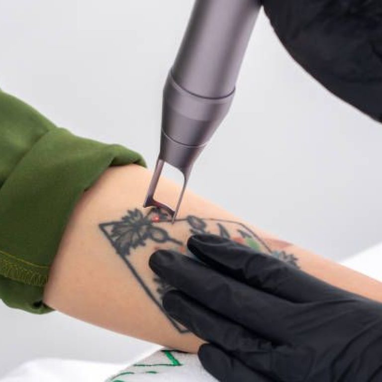 Laser Tatoeage Verwijderen bij Beauty Clinic Rasa