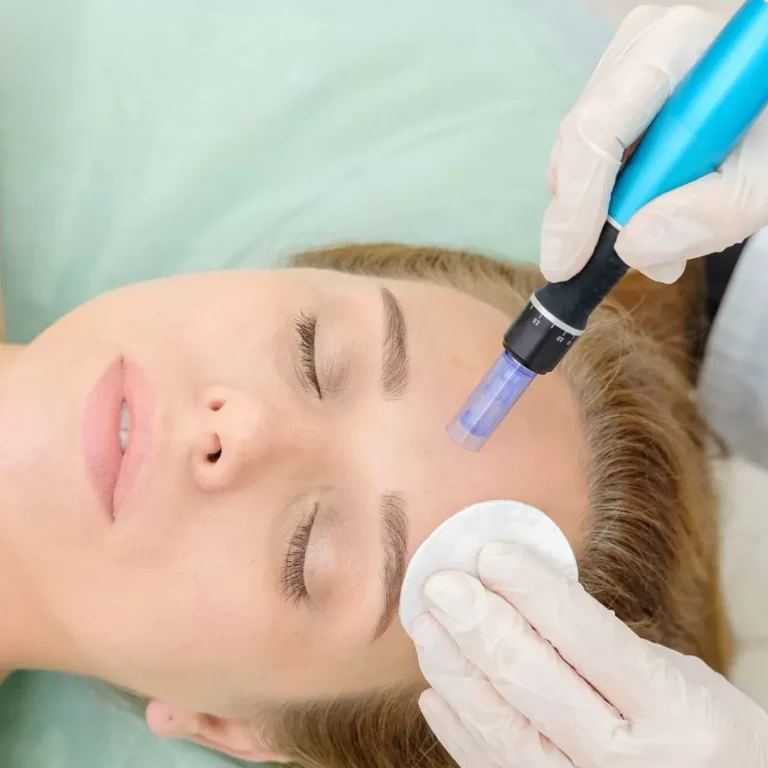 Microneedling Treatment